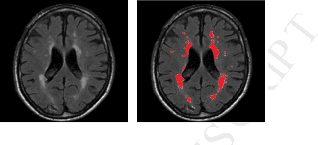 Figure 1 for Fully Convolutional Network Ensembles for White Matter Hyperintensities Segmentation in MR Images