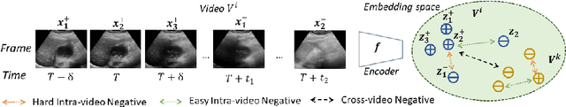 Figure 1 for Unsupervised Contrastive Learning of Image Representations from Ultrasound Videos with Hard Negative Mining