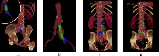 Figure 2 for Determination, Calculation and Representation of the Upper and Lower Sealing Zones During Virtual Stenting of Aneurysms
