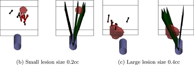Figure 4 for Strategising template-guided needle placement for MR-targeted prostate biopsy