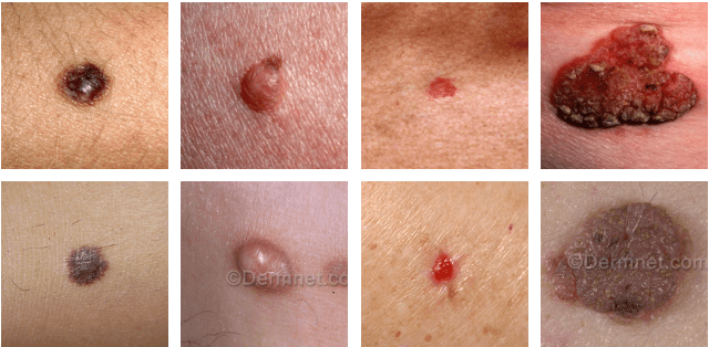 Figure 1 for Skin Disease Classification versus Skin Lesion Characterization: Achieving Robust Diagnosis using Multi-label Deep Neural Networks