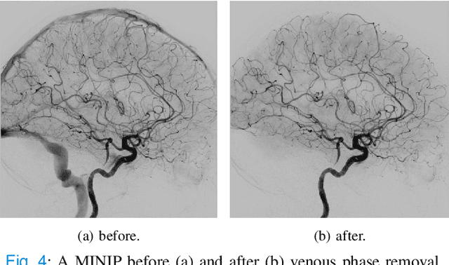 Figure 4 for autoTICI: Automatic Brain Tissue Reperfusion Scoring on 2D DSA Images of Acute Ischemic Stroke Patients