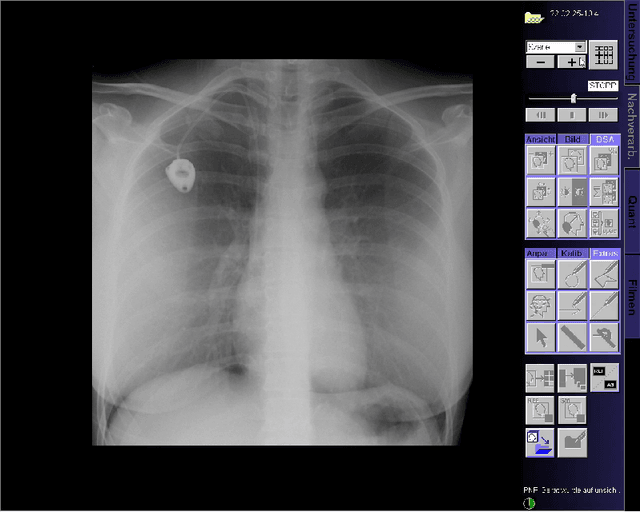 Figure 3 for PoCaP Corpus: A Multimodal Dataset for Smart Operating Room Speech Assistant using Interventional Radiology Workflow Analysis