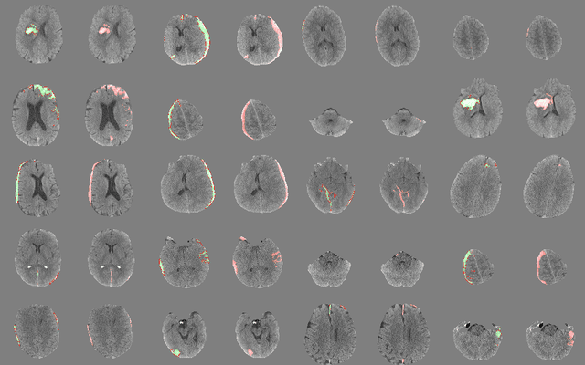 Figure 1 for PatchFCN for Intracranial Hemorrhage Detection