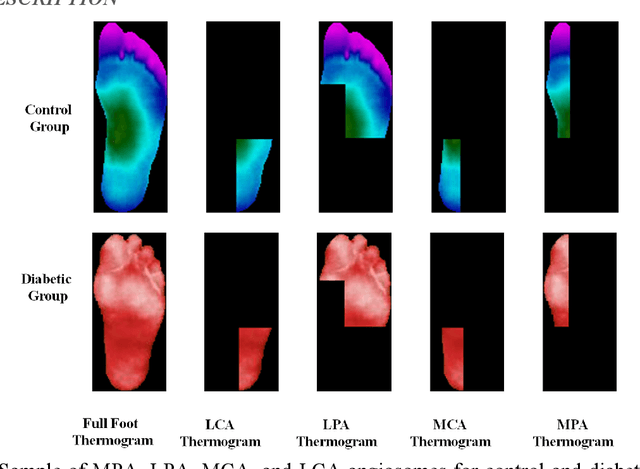 Figure 2 for A Machine Learning Model for Early Detection of Diabetic Foot using Thermogram Images