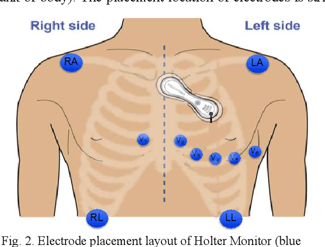 Figure 2 for Real-Time ECG Interval Monitoring Using a Fully Disposable Wireless Patch Sensor