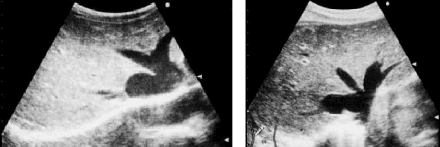 Figure 1 for Improving the Otsu Thresholding Method of Global Binarization Using Ring Theory for Ultrasonographies of Congestive Heart Failure