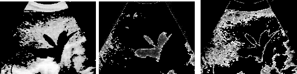 Figure 3 for Improving the Otsu Thresholding Method of Global Binarization Using Ring Theory for Ultrasonographies of Congestive Heart Failure
