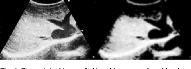 Figure 4 for Improving the Otsu Thresholding Method of Global Binarization Using Ring Theory for Ultrasonographies of Congestive Heart Failure