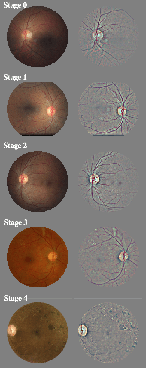 Figure 1 for Case Study: Explaining Diabetic Retinopathy Detection Deep CNNs via Integrated Gradients