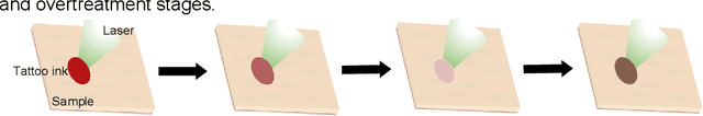 Figure 1 for Photoacoustic-monitored laser treatment for tattoo removal: a feasibility study