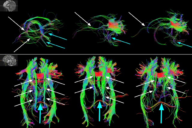 Figure 4 for A machine learning-based method for estimating the number and orientations of major fascicles in diffusion-weighted magnetic resonance imaging