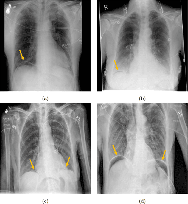 Figure 3 for Sensitivity and Specificity Evaluation of Deep Learning Models for Detection of Pneumoperitoneum on Chest Radiographs