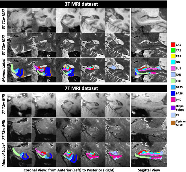 Figure 1 for Deep Label Fusion: A 3D End-to-End Hybrid Multi-Atlas Segmentation and Deep Learning Pipeline