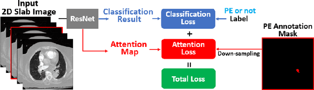 Figure 1 for Automatic Diagnosis of Pulmonary Embolism Using an Attention-guided Framework: A Large-scale Study