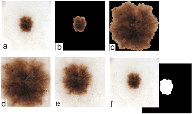 Figure 3 for The Effects of Skin Lesion Segmentation on the Performance of Dermatoscopic Image Classification