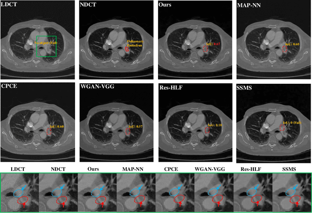 Figure 4 for Lesion-Inspired Denoising Network: Connecting Medical Image Denoising and Lesion Detection