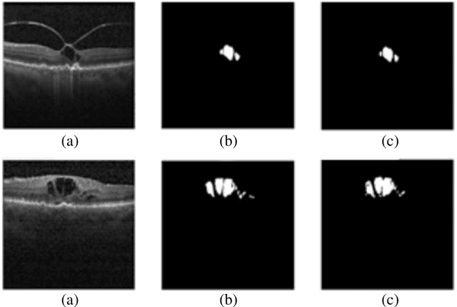 Figure 1 for Fluid segmentation in Neutrosophic domain