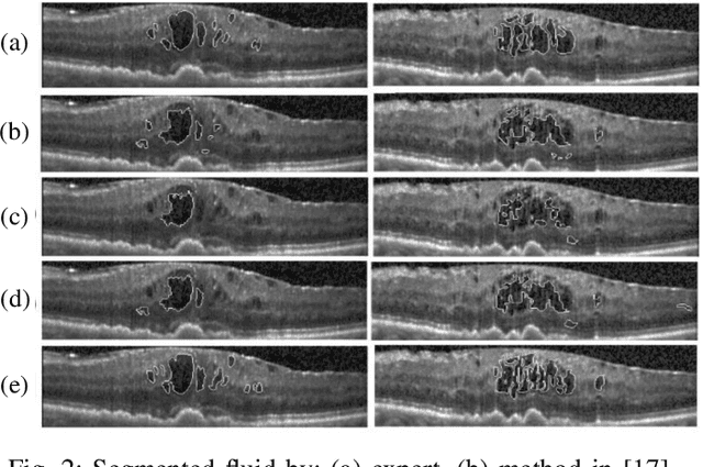 Figure 2 for Fluid segmentation in Neutrosophic domain