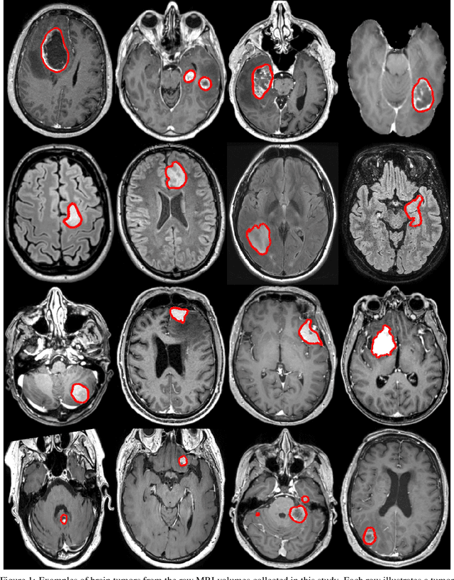 Figure 1 for Preoperative brain tumor imaging: models and software for segmentation and standardized reporting