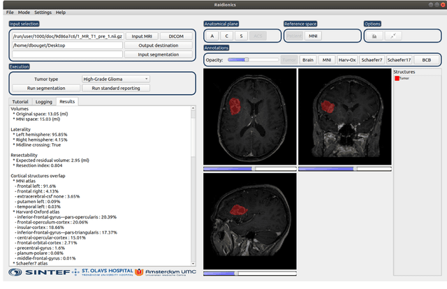 Figure 4 for Preoperative brain tumor imaging: models and software for segmentation and standardized reporting
