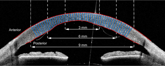 Figure 1 for Corneal Pachymetry by AS-OCT after Descemet's Membrane Endothelial Keratoplasty
