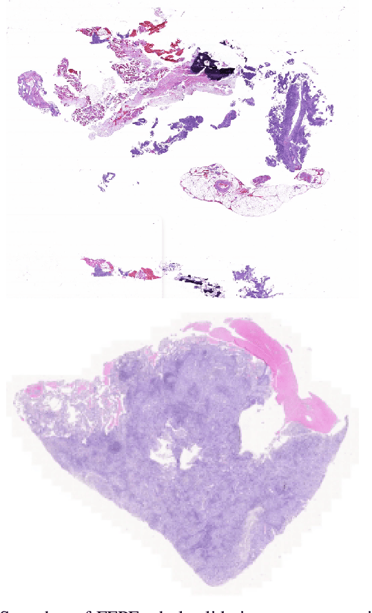 Figure 1 for EGFR Mutation Prediction of Lung Biopsy Images using Deep Learning