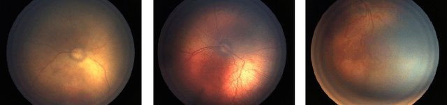 Figure 1 for Deep Learning from Small Amount of Medical Data with Noisy Labels: A Meta-Learning Approach