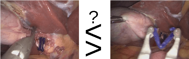 Figure 1 for Unsupervised temporal context learning using convolutional neural networks for laparoscopic workflow analysis