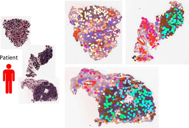 Figure 3 for Whole Slide Images based Cancer Survival Prediction using Attention Guided Deep Multiple Instance Learning Networks
