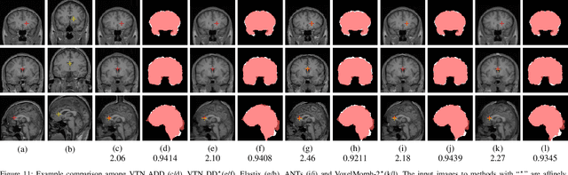 Figure 3 for Unsupervised 3D End-to-End Medical Image Registration with Volume Tweening Network