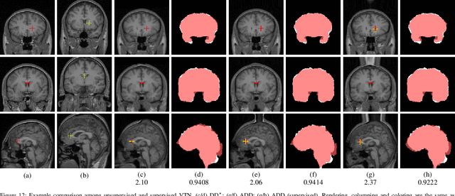 Figure 4 for Unsupervised 3D End-to-End Medical Image Registration with Volume Tweening Network