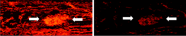 Figure 3 for Learned super resolution ultrasound for improved breast lesion characterization