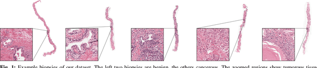 Figure 1 for Detection of prostate cancer in whole-slide images through end-to-end training with image-level labels