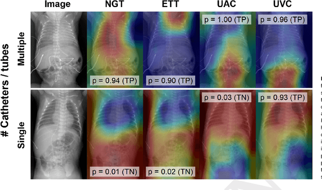 Figure 4 for Automatic classification of multiple catheters in neonatal radiographs with deep learning