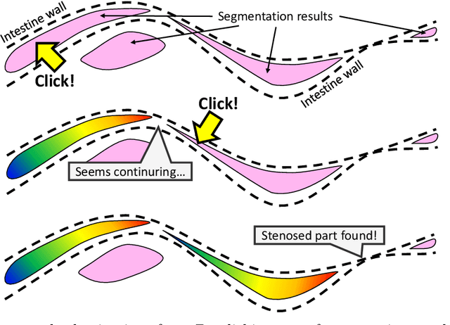 Figure 3 for Visualizing intestines for diagnostic assistance of ileus based on intestinal region segmentation from 3D CT images