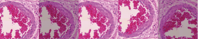 Figure 3 for Colorectal Cancer Outcome Prediction from H&E Whole Slide Images using Machine Learning and Automatically Inferred Phenotype Profiles