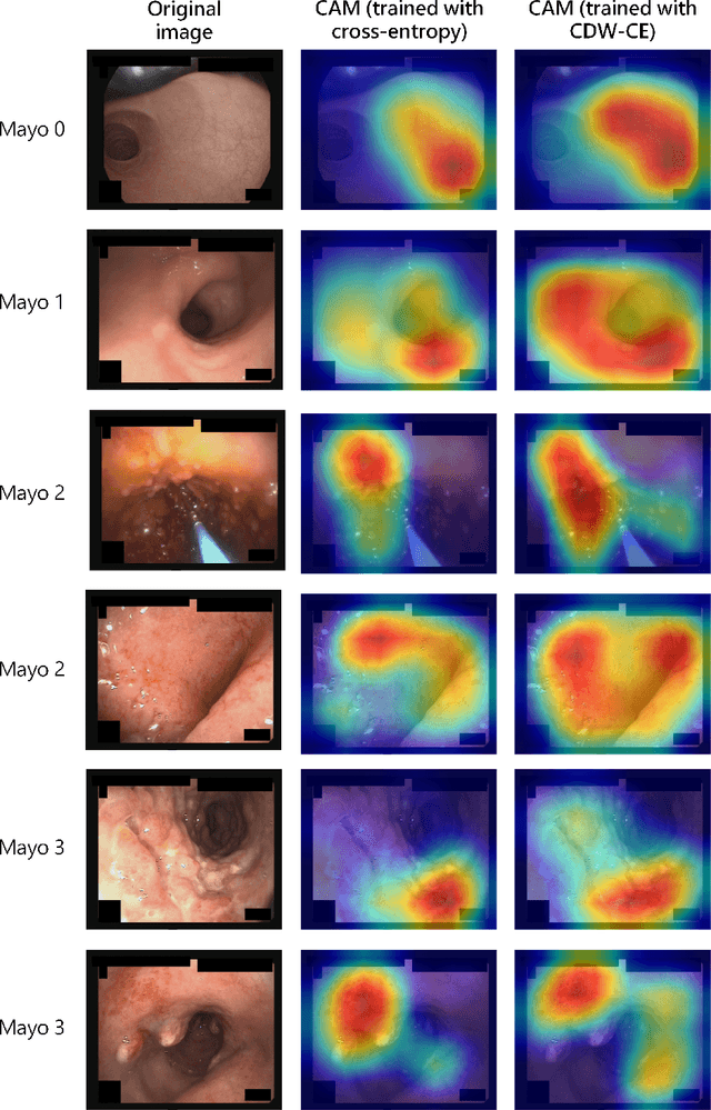Figure 2 for Class Distance Weighted Cross-Entropy Loss for Ulcerative Colitis Severity Estimation