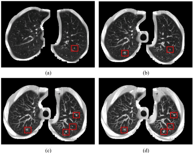 Figure 3 for Automatic Pulmonary Nodule Detection in CT Scans Using Convolutional Neural Networks Based on Maximum Intensity Projection
