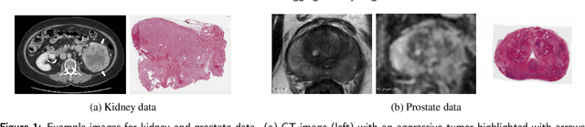 Figure 1 for Correlated Feature Aggregation by Region Helps Distinguish Aggressive from Indolent Clear Cell Renal Cell Carcinoma Subtypes on CT