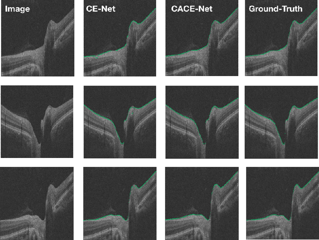 Figure 4 for The Channel Attention based Context Encoder Network for Inner Limiting Membrane Detection