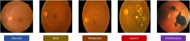 Figure 1 for Automated Diabetic Retinopathy Grading using Deep Convolutional Neural Network