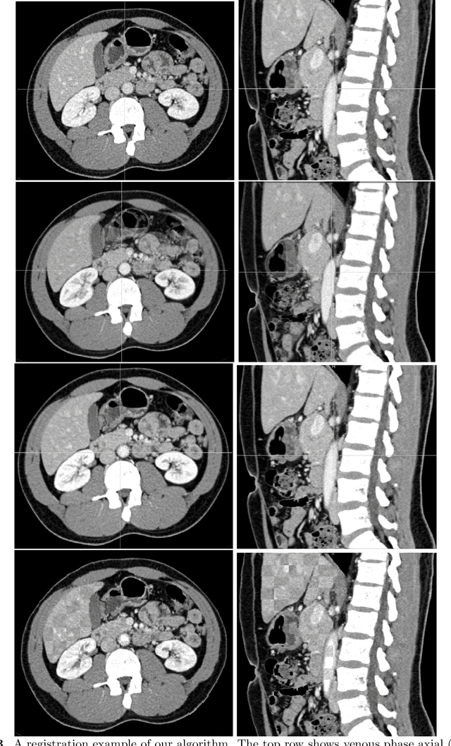 Figure 4 for Multi-phase Deformable Registration for Time-dependent Abdominal Organ Variations