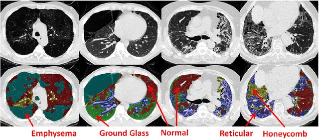 Figure 1 for Holistic Interstitial Lung Disease Detection using Deep Convolutional Neural Networks: Multi-label Learning and Unordered Pooling