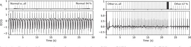 Figure 2 for Beat by Beat: Classifying Cardiac Arrhythmias with Recurrent Neural Networks