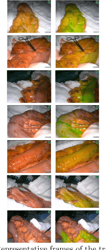 Figure 2 for Fluorescence angiography classification in colorectal surgery -- A preliminary report