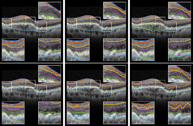 Figure 3 for Pathological OCT Retinal Layer Segmentation using Branch Residual U-shape Networks