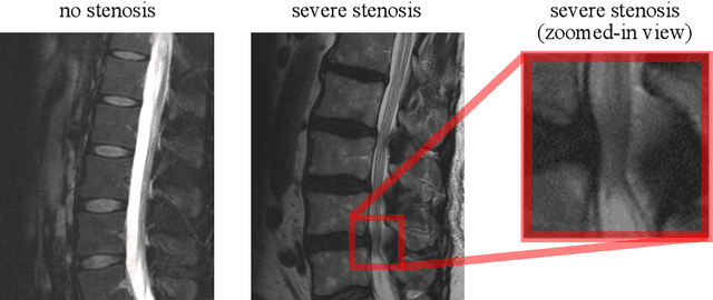 Figure 4 for Improving Trustworthiness of AI Disease Severity Rating in Medical Imaging with Ordinal Conformal Prediction Sets