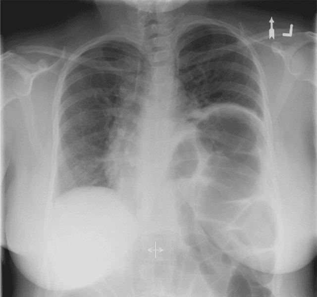 Figure 1 for Quantitative analysis of diaphragm motion during fluoroscopic sniff test to assist in diagnosis of hemidiaphragm paralysis