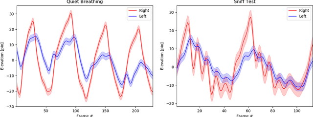 Figure 3 for Quantitative analysis of diaphragm motion during fluoroscopic sniff test to assist in diagnosis of hemidiaphragm paralysis